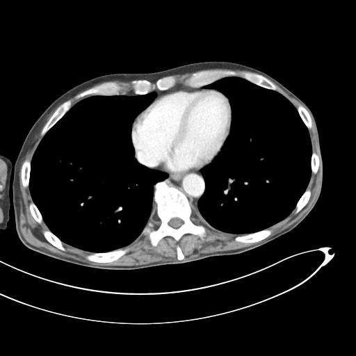 Bone metastasis from squamous cell carcinoma (Radiopaedia 30133-30730 B 3).jpg