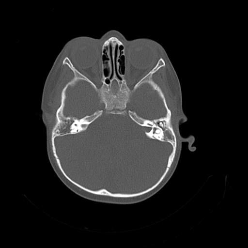 File:Bony atresia of the right external auditory canal (Radiopaedia 27916-28156 Axial bone window 8).jpg