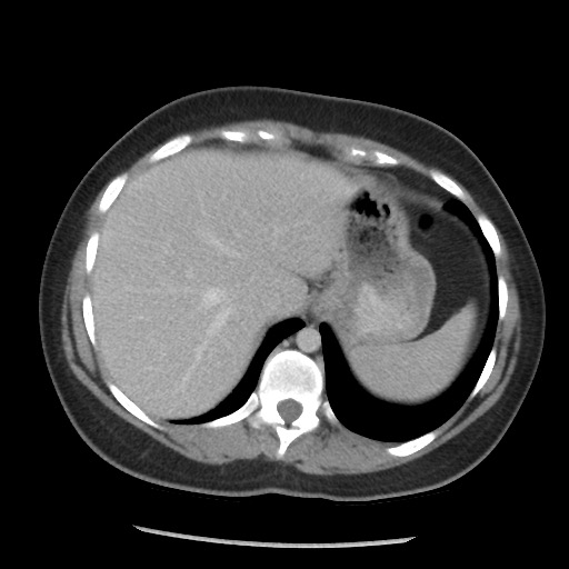 File:Borderline mucinous tumor (ovary) (Radiopaedia 78228-90808 A 68).jpg