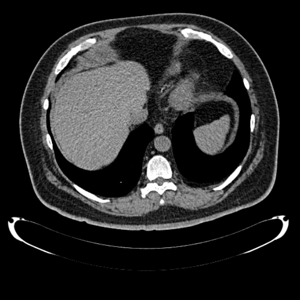 Bosniak renal cyst - type IV (Radiopaedia 24244-24518 Axial non-contrast 43).jpg