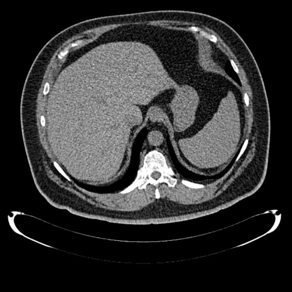 Bosniak renal cyst - type IV (Radiopaedia 24244-24518 Axial non-contrast 71).jpg