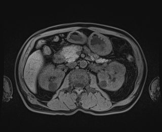 Bouveret syndrome (Radiopaedia 61017-68856 Axial T1 fat sat 40).jpg