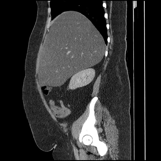 Bowel and splenic infarcts in acute lymphocytic leukemia (Radiopaedia 61055-68913 C 56).jpg