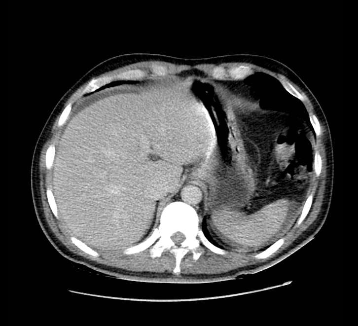 Bowel obstruction from colon carcinoma (Radiopaedia 22995-23028 A 15).jpg