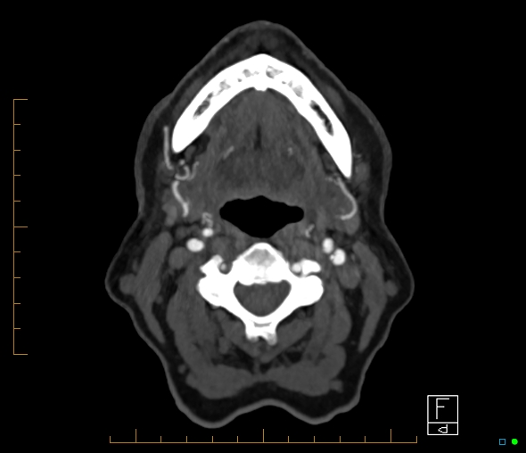 Brachiocephalic trunk stenosis (Radiopaedia 87242-103519 A 87).jpg