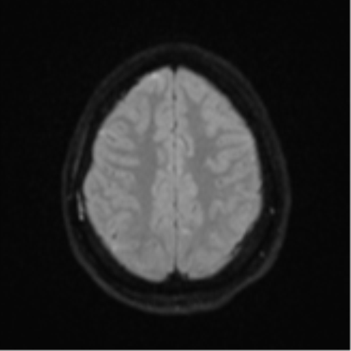 Brain death (Radiopaedia 43754-47237 Axial DWI 21).png