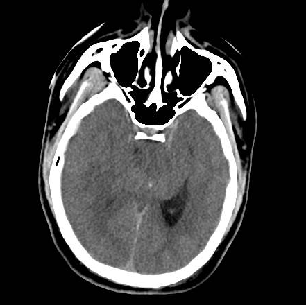 File:Brain death after motor vehicle collision (Radiopaedia 88470-105114 Axial 7).png