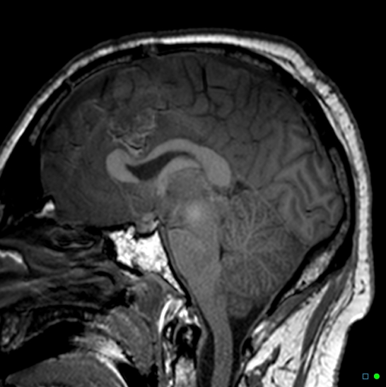 Brain death on MRI and CT angiography (Radiopaedia 42560-45689 Sagittal T1 26).jpg