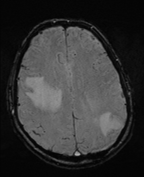 Brain metastases - lung cancer primary (Radiopaedia 75060-86115 Axial SWI 40).jpg