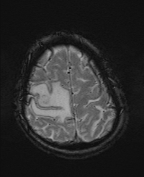 Brain metastases - lung cancer primary (Radiopaedia 75060-86115 Axial SWI 51).jpg