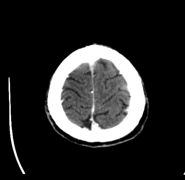 File:Brain metastases from lung cancer (Radiopaedia 24480-24781 Axial C+ delayed 57).jpg