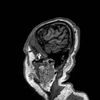 Brain metastases from lung cancer (Radiopaedia 83839-99028 Sagittal T1 121).jpg