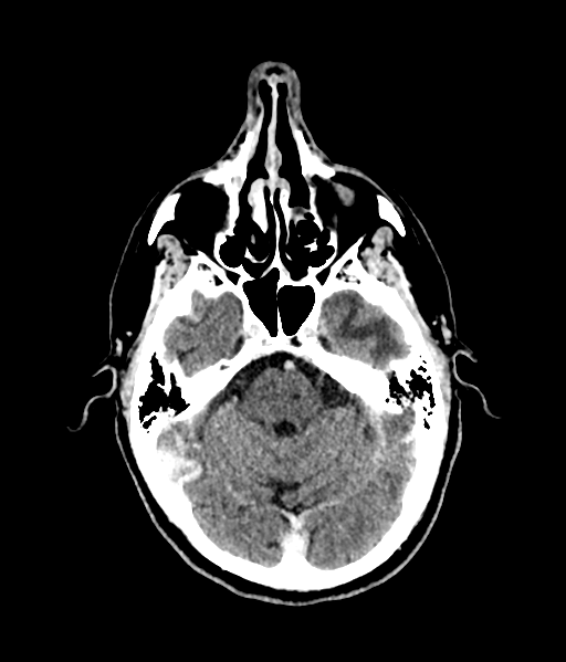 Brain metastasis (large cystic mass) (Radiopaedia 47497-52106 Axial C+ 22).png