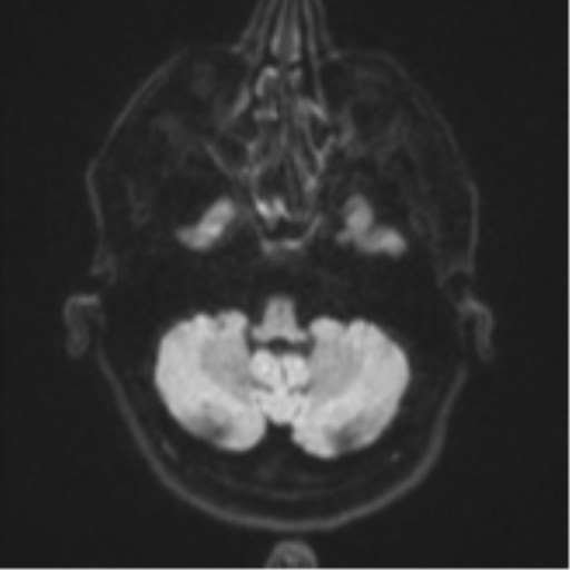 File:Brain metastasis (large cystic mass) (Radiopaedia 47497-52107 Axial DWI 33).png