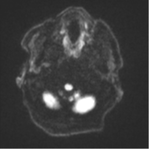 Brain metastasis (lung cancer) (Radiopaedia 48289-53179 Axial DWI 29).png