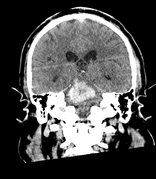 Brainstem hemorrhage (Radiopaedia 81294-94976 Coronal non-contrast 41).jpg