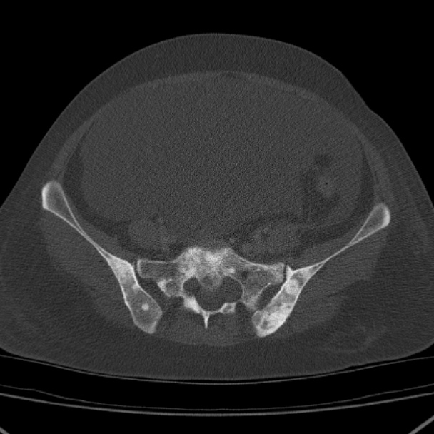 Breast cancer metastases - hepatic and skeletal (Radiopaedia 34201-35461 Axial bone window 84).jpg