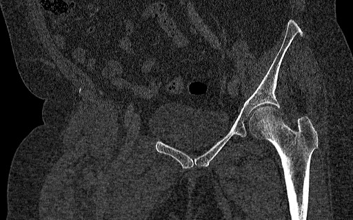 Breast carcinoma with pathological hip fracture (Radiopaedia 60314-67993 Coronal bone window 61).jpg