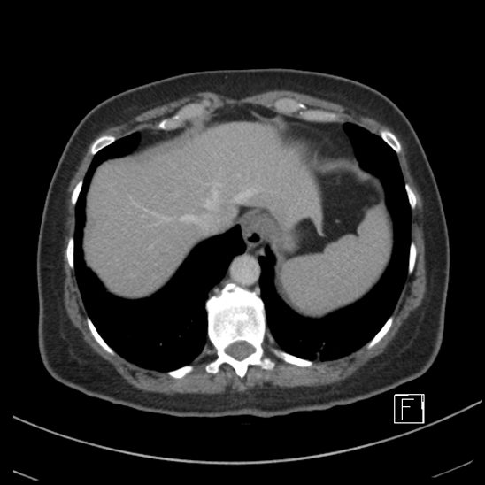 Breast metastases from renal cell cancer (Radiopaedia 79220-92225 C 10).jpg