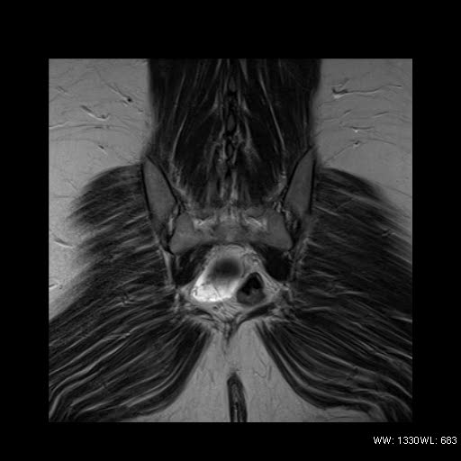 File:Broad ligament fibroid (Radiopaedia 49135-54241 Coronal T2 24).jpg