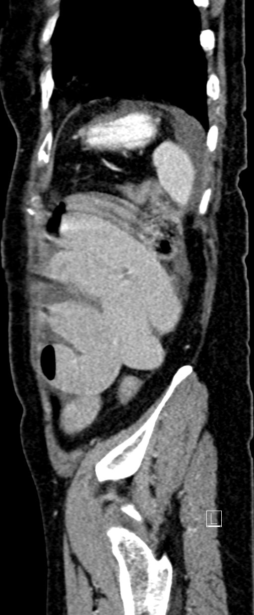 Broad ligament hernia (Radiopaedia 84802-100276 C 7).jpg