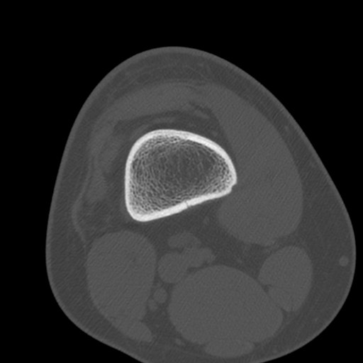 Brodie abscess of the tibia (Radiopaedia 58984-66250 Axial bone window 5).jpg