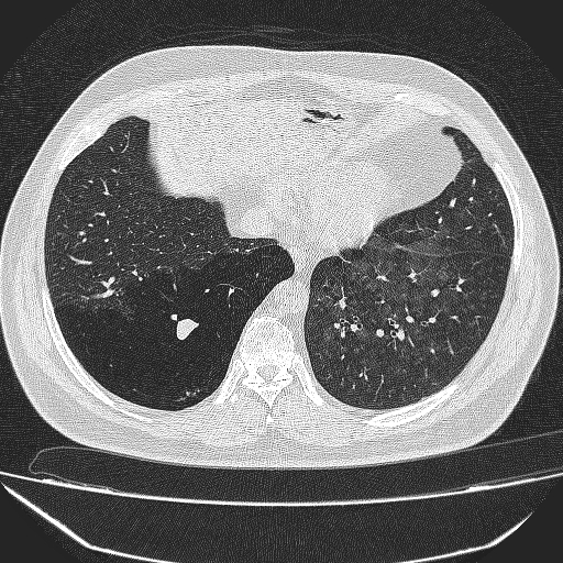 File:Bronchial atresia (Radiopaedia 58271-65417 Axial lung window 36).jpg