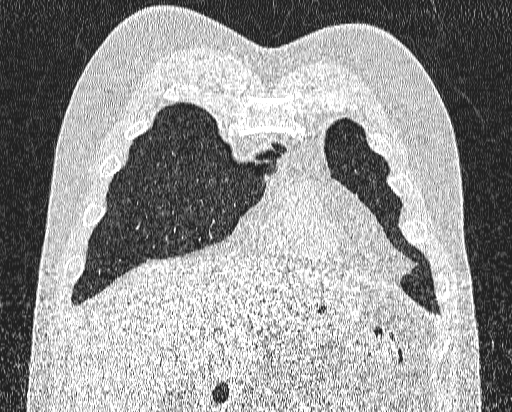 File:Bronchial atresia (Radiopaedia 58271-65417 Coronal lung window 7).jpg