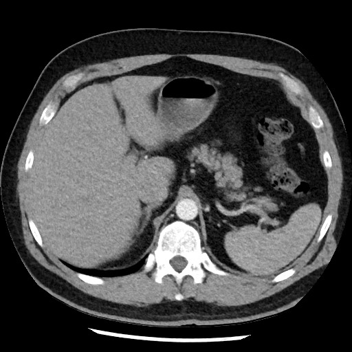 Bronchial carcinoid tumor (Radiopaedia 67377-76764 A 60).jpg