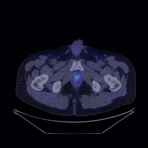 Bronchial carcinoid tumor (Radiopaedia 67377-76765 68Ga-DOTATATE PET-CT 75).jpg