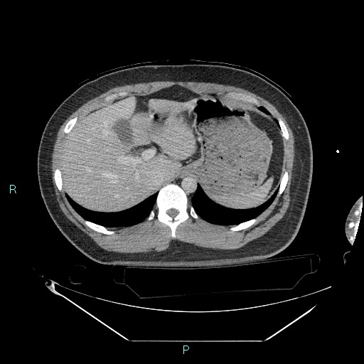 Bronchial carcinoid tumor (Radiopaedia 78272-90870 C 112).jpg