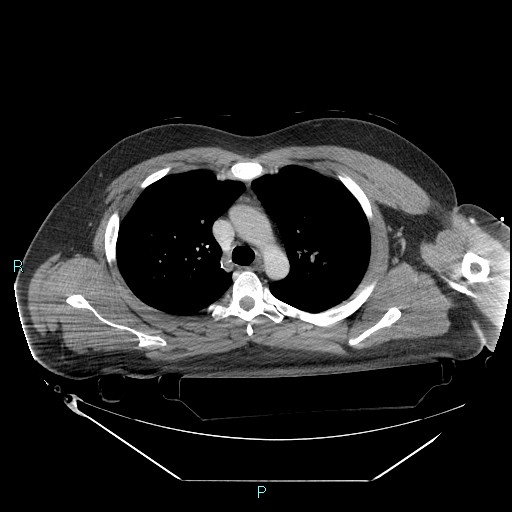 Bronchial carcinoid tumor (Radiopaedia 78272-90870 C 42).jpg