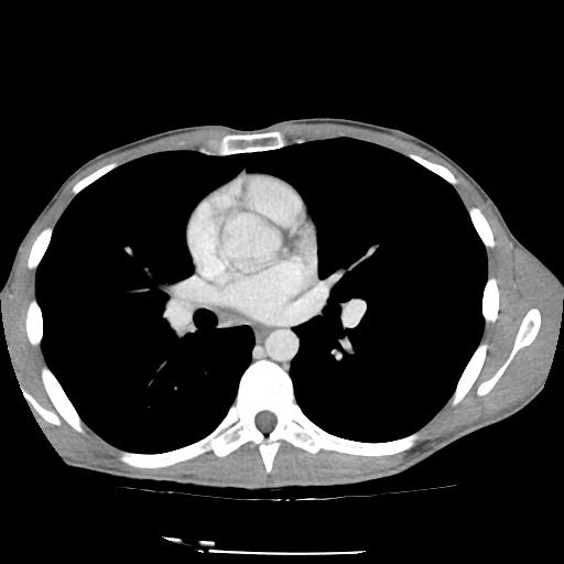 Bronchial carcinoid tumor causing right lower lobe collapse (Radiopaedia 83495-98594 A 26).jpg