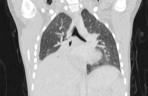 Bronchial mucoepidermoid carcinoma (Radiopaedia 57023-63895 Coronal lung window 22).jpg