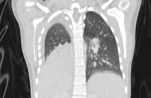 Bronchial mucoepidermoid carcinoma (Radiopaedia 57023-63895 Coronal lung window 58).jpg