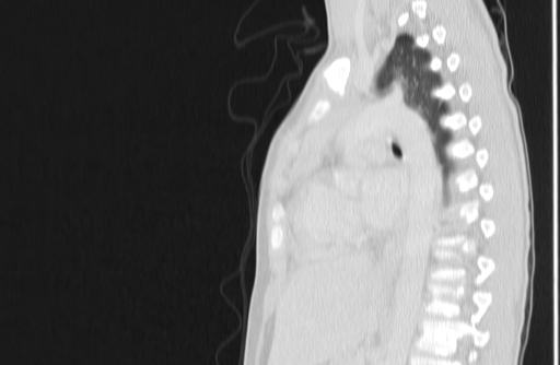 Bronchial mucoepidermoid carcinoma (Radiopaedia 57023-63895 Sagittal lung window 101).jpg