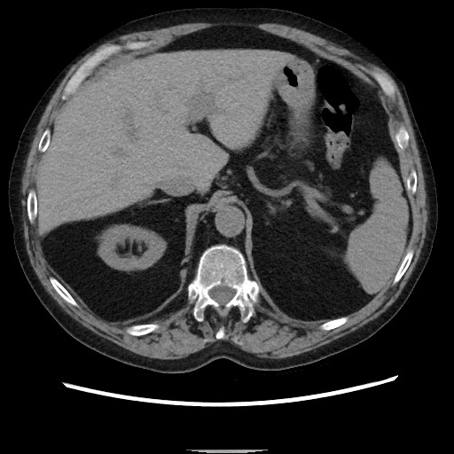 Bronchial stenosis - lung transplant (Radiopaedia 73133-83848 Axial non-contrast 58).jpg