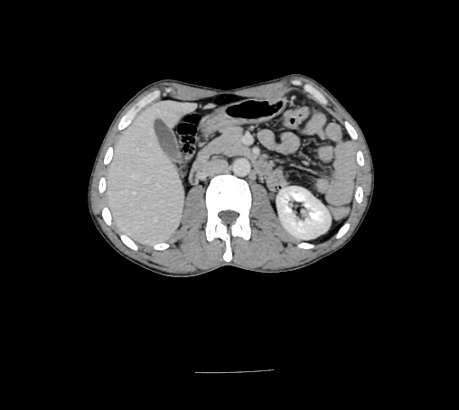 File:Bronchiectasis in Crohn disease (Radiopaedia 60311-67977 B 67).jpg