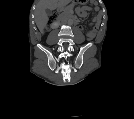 Bronchiectasis in Crohn disease (Radiopaedia 60311-67977 Coronal bone window 50).jpg