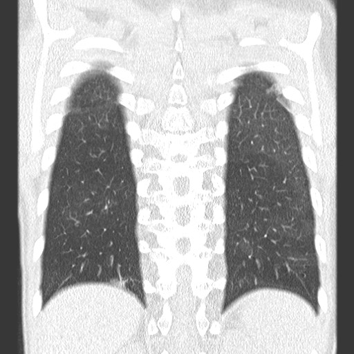 File:Bronchiolotis obliterans (Radiopaedia 73769-84575 Coronal lung window 32).jpg