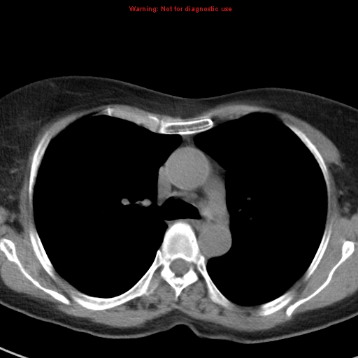 File:Bronchoalveolar carcinoma (BAC) (Radiopaedia 13436-13392 Axial non-contrast 20).jpg