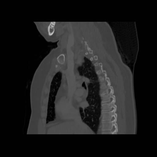 Bronchogenic carcinoma (Radiopaedia 73497-84262 Sagittal bone window 73).jpg
