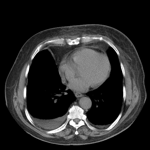Bronchogenic carcinoma with metastatic lymphadenopathy (Radiopaedia 37671-39569 Axial non-contrast 36).jpg