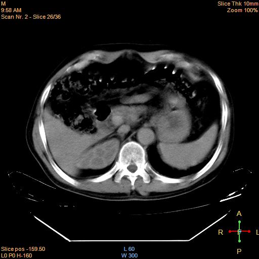 File:Bronchogenic carcinoma with superior vena caval invasion (Radiopaedia 22378-22406 Mediastinal window 23).jpg