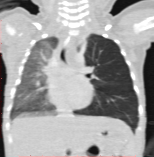 Bronchogenic cyst (Radiopaedia 78599-91409 Coronal lung window 120).jpg