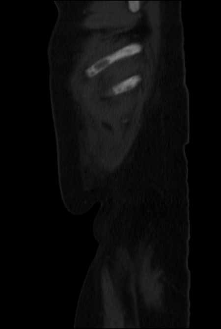 Brown tumors compressing the spinal cord (Radiopaedia 68442-77988 H 54).jpg
