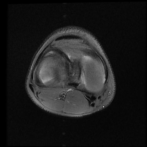 File:Bucket handle tear - lateral meniscus (Radiopaedia 72124-82634 Axial PD fat sat 10).jpg