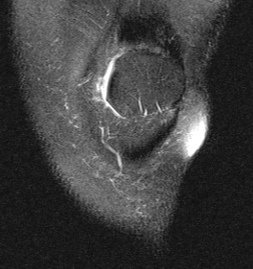 File:Bucket handle tear - medial meniscus (Radiopaedia 79028-91942 Coronal PD fat sat 22).jpg
