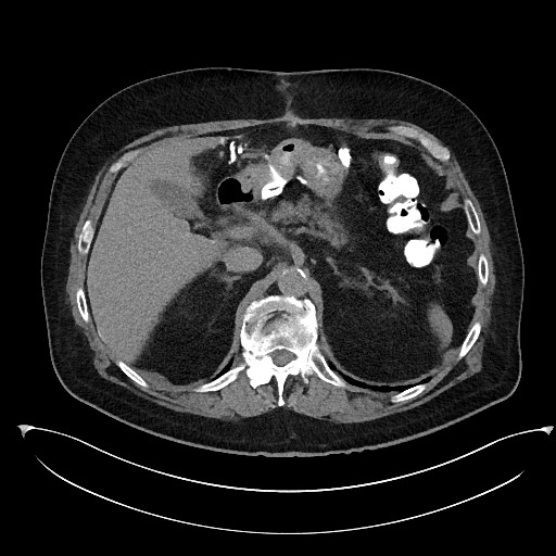 File:Buried bumper syndrome - gastrostomy tube (Radiopaedia 63843-72577 Axial Inject 27).jpg