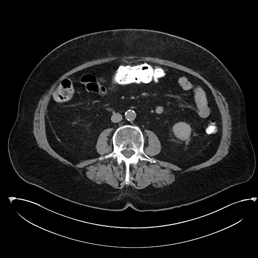 File:Buried bumper syndrome - gastrostomy tube (Radiopaedia 63843-72577 Axial Inject 58).jpg